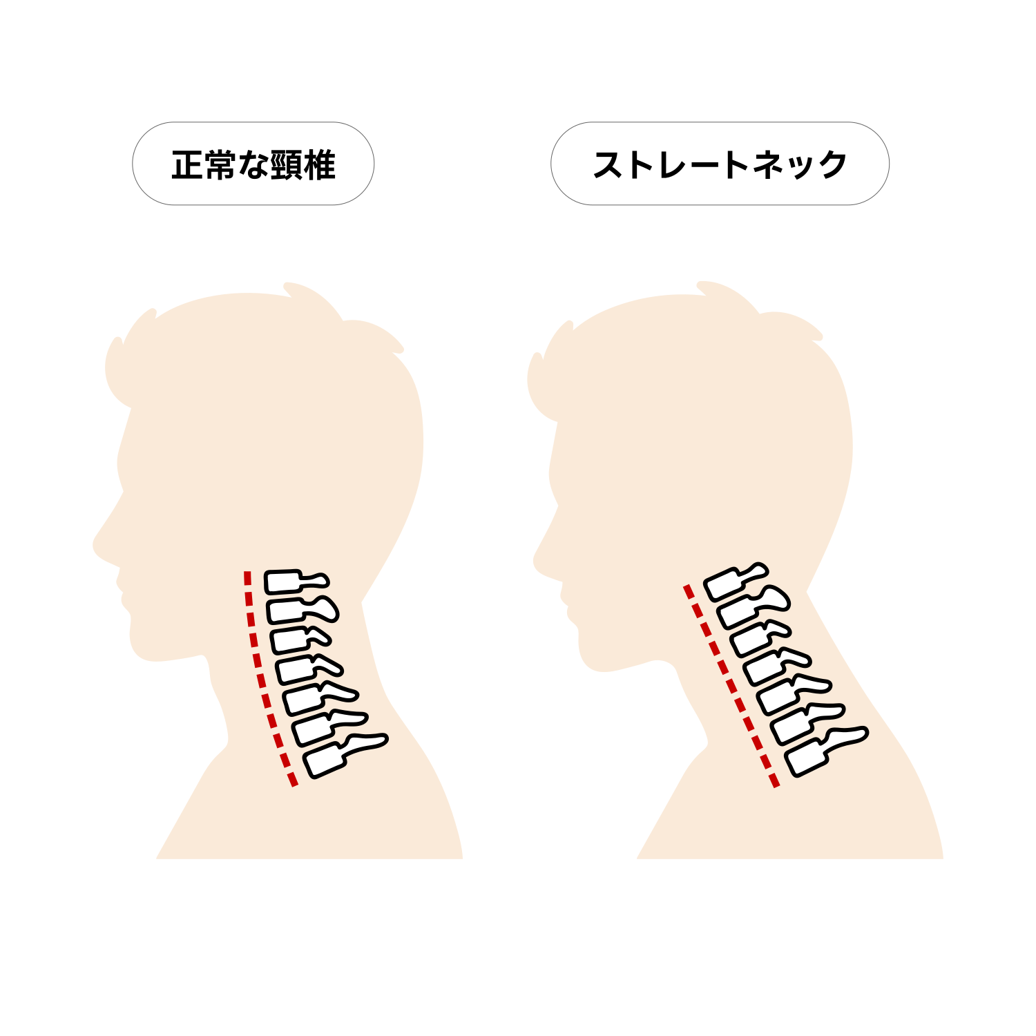 正常な頸椎とストレートネックの比較イラスト（成人男性・補助ライン付き・シルエット）