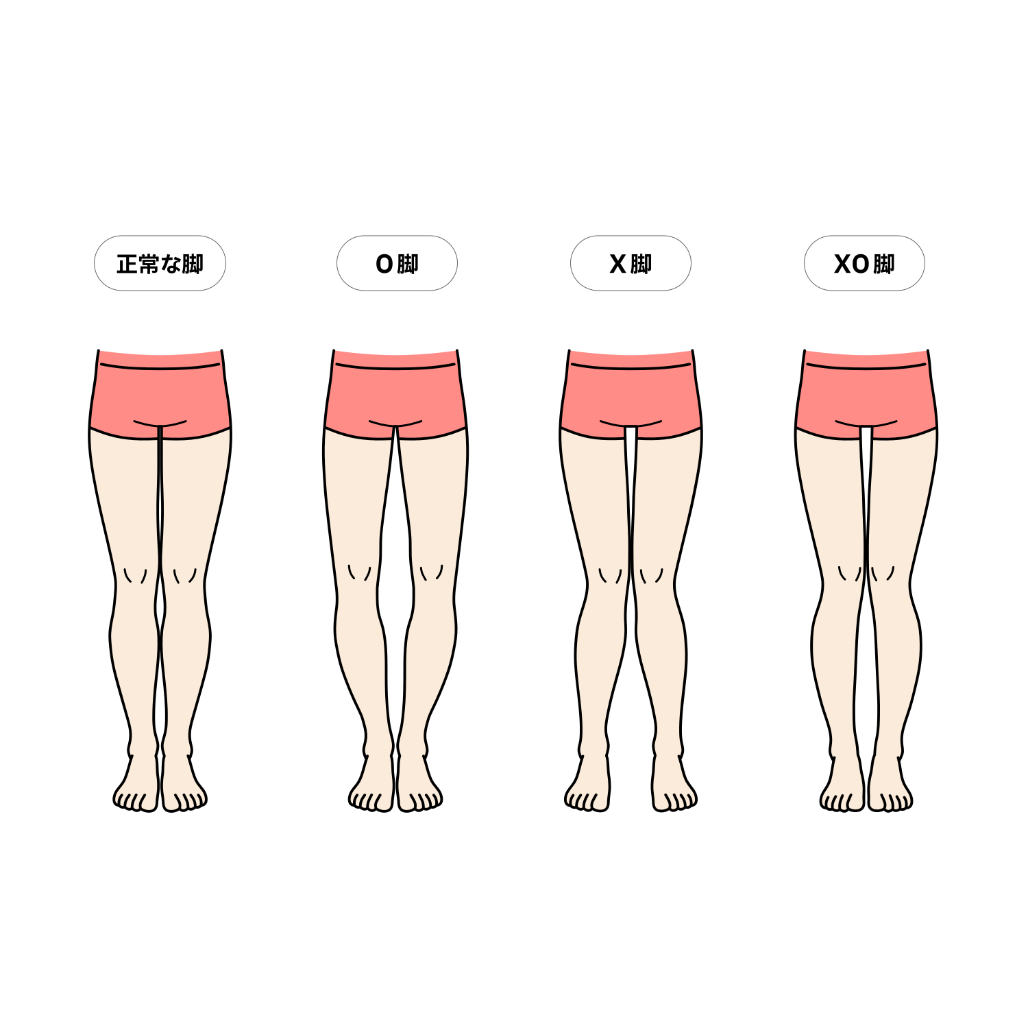 正常な脚とO脚・X脚・XO脚の比較イラスト（男性）