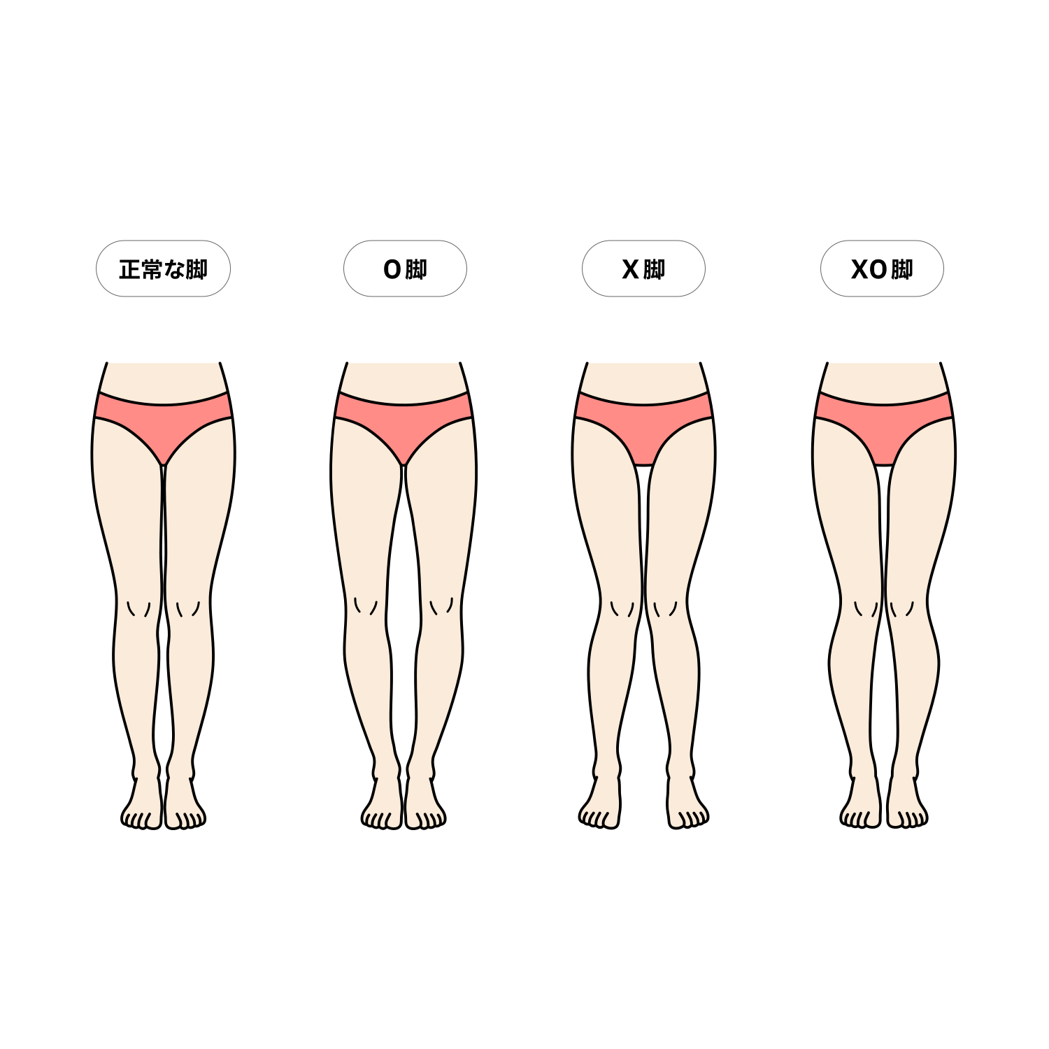 正常な脚とO脚・X脚・XO脚の比較イラスト（女性）